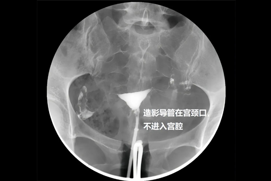 助力好“孕”！无麻醉、无痛子宫输卵管造影有“备”而来，打消备孕女性的疼痛焦虑