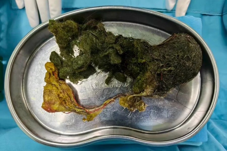 极为罕见！5岁男孩确诊“长发公主综合征”，家长：打小爱吃头发、卫生纸、棉絮……