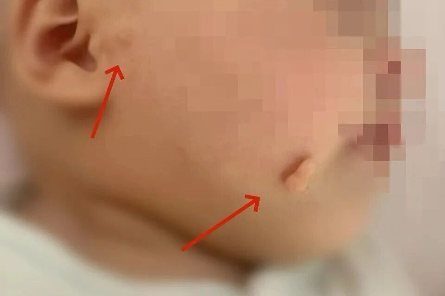 “拴马桩”竟长到了娃嘴角，是福气动不得？宝妈犯了愁，专家有话说