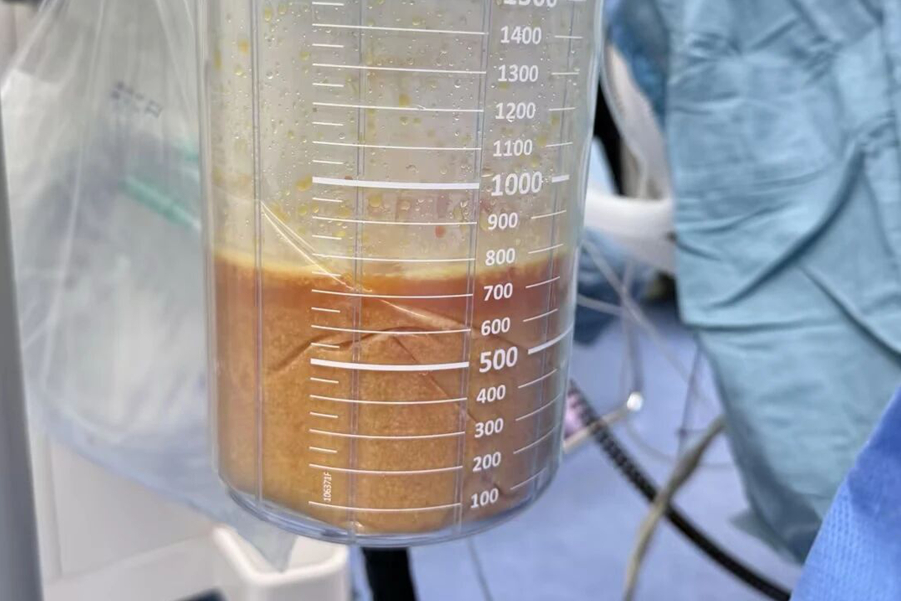 “奥美定”隆胸20年,女子自称双乳胀痛濒临炸裂!专家联手取出1250ml浑浊混合液